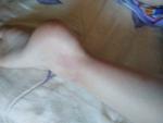Красно-фиолетовые пятна на ногах ребёнка фото 1