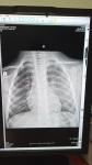 Рентген лёгких. Помогите понять фото 1