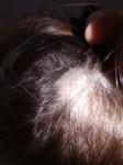 Выпадение волос очагами фото 4