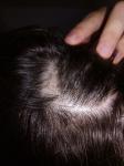 Выпадение волос очагами фото 3