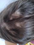 Выпадение волос очагами фото 1