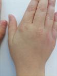 Сыпь на кистях рук у ребенка фото 2