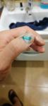 Травма ногтевой пластины большого пальца руки фото 2