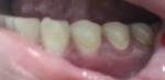 Белые пятна на зубах фото 1