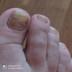Как лечить грибок ногтей ног фото 2