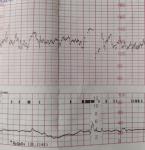 Низкое значение КТГ 40 недель фото 3
