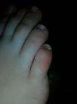 Тёмное пятно на ногте на ноге фото 4