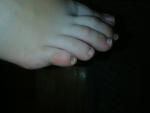 Тёмное пятно на ногте на ноге фото 3