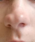 Странный нос с ринитом фото 1