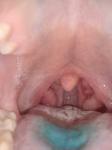Боль в горле, не проходит, сверху миндалины гранулы фото 1