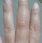 После пореза опух палец фото 2