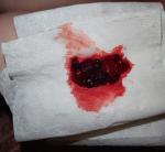 Кровотечение после прижигания эрозии лазером фото 1