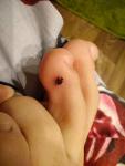 Меланома или гематома на пальце ноги у родростка фото 2