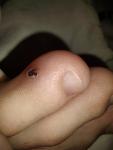 Меланома или гематома на пальце ноги у родростка фото 1