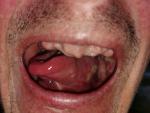 Стоматит рта гной фото 3