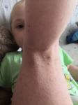 Сыпь у ребёнка с вулдырями фото 2
