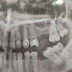 Боль в зубе без нерва через год фото 1