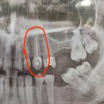 Боль в зубе без нерва через год фото 2