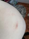 Сыпь во время беременности, красные прыщи и зуд без температуры фото 4