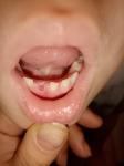 Осколок зуба или пострянный фото 1