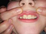 Зубной налет у ребенка фото 1
