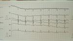 Расшифровка Электрокардиографии фото 1