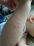 Странная сыпь у ребёнка, нет точного диагноза фото 1