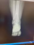 Белое пятно на рентгене б/берцовой кости фото 2