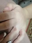 Темные пятна у ребенка между пальцами рук фото 1