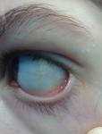 Гепатит Б, желтый оттенок склер глаз фото 1