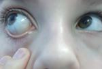 Гепатит Б, желтый оттенок склер глаз фото 2