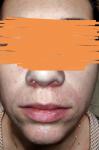 Чем лечить дерматит на лице? фото 1