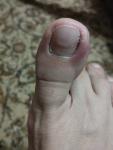 Воспаление сбоку от ногтя на большом пальце ноги фото 1