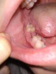 Болит десна после удаления зуба фото 2
