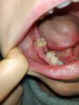 Болит десна после удаления зуба фото 1