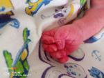 Слазеная кожа на пальцев у новорожденного. Пожалуйста срочно нужен ответ фото 2