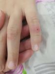 Воспаления на пальцах рук с гноем фото 1