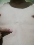 Уплотнение в середине груди фото 1
