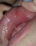 Язва на внутренне стороне губы - стоматит, герпес или? фото 1