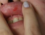 Язва на внутренне стороне губы - стоматит, герпес или? фото 2