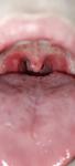 Красная сыпь в горле у ребёнка, белые пузырьки на миндалинах фото 1