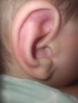 Гематома уха фото 1