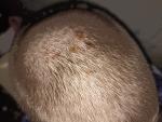 Красные пятна в волосистой части головы фото 3