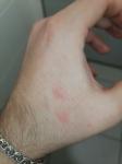 Непонятные воспаления на руке, есть фото фото 2