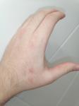 Непонятные воспаления на руке, есть фото фото 1