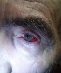 Кровоизлияние в левый глаз фото 1