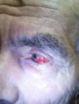 Кровоизлияние в левый глаз фото 2