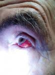 Кровоизлияние в левый глаз фото 3