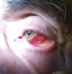 Кровоизлияние в левый глаз фото 4