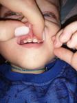 У ребёнка в 1гол 4 месяца тёмные пятна на передних зубах фото 1